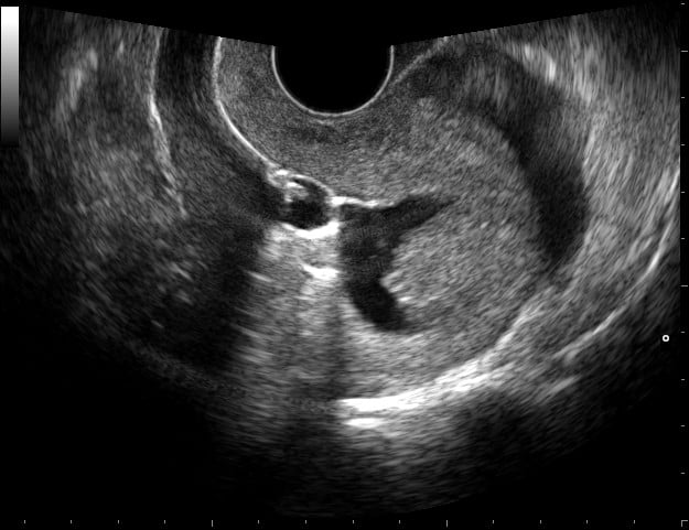 Sonohysterography.jpg Sonohysterography.jpg