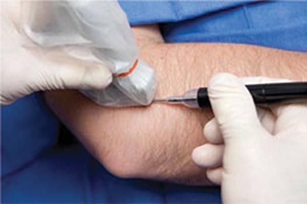 tenex tendonitis treatment des moines tenex tendonitis treatment des moines